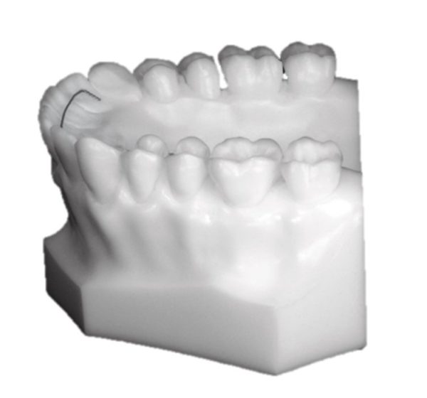 Fixed Bonded Retainer Upper – Lower – BM Ortho Appliances Inc.