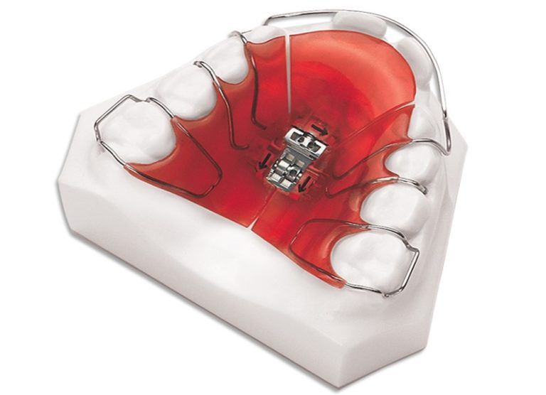 3 Way Expander BM Ortho Appliances Inc.