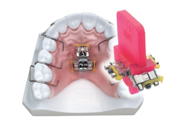 3 Way Expander – BM Ortho Appliances Inc.