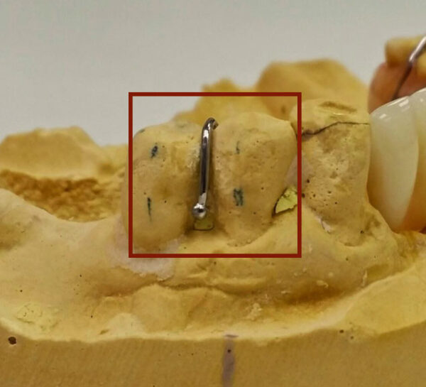 AccessoriesClasps in Removable Orthodontics BM Ortho Appliances Inc.