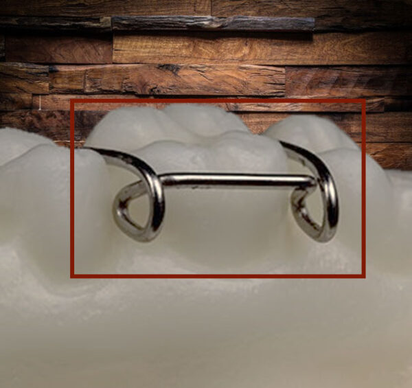 AccessoriesClasps in Removable Orthodontics BM Ortho Appliances Inc.